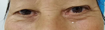 功能性溢泪治疗前1.png